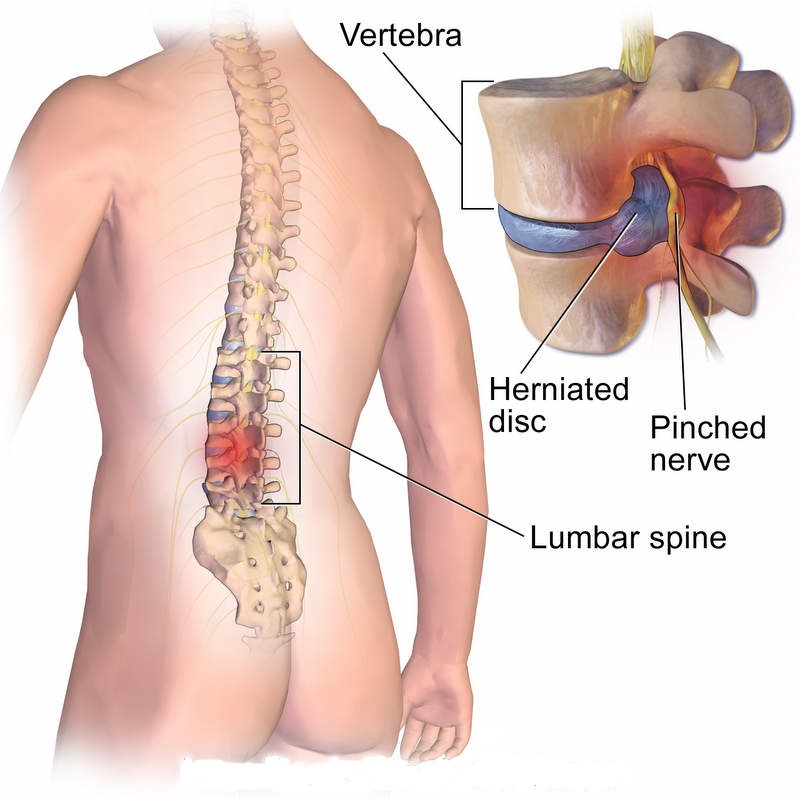 Vertebra-Herniated-Disc-Pinched-Nerve-Lower-Back-Spine