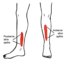 Shin Splits (Medial Tibial Stress Syndrome) | PhysioFinesse